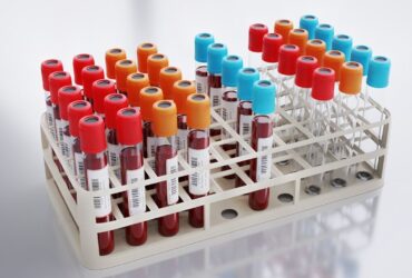 P24 Antijen Testi Nedir ve Nasıl Yapılır?