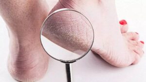 Topuk Çatlakları Evde Nasıl Tedavi Edilir? Sebepleri Nelerdir?